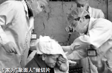 罕见“象面人”引关注 专家会诊拟为其变脸(图)--中国国情