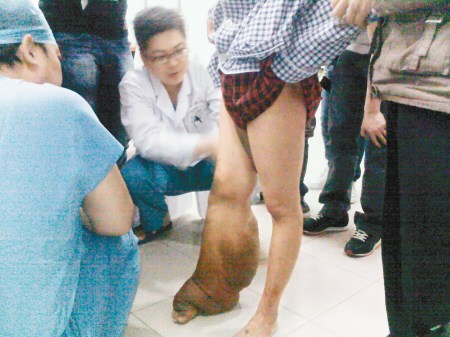 少女小腿粗如“象腿” 抬脚行走如拖一袋面(图)--中国国情