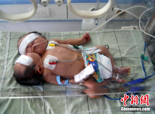 重庆医院收治罕见双头女婴 暂不分离保全性命(图)--中国国情网