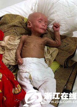 婴儿接种卡介苗后生命进倒计时 家属捐出经济补偿--中国国情手册