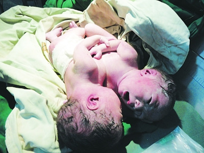 孕妇剖腹产下连体男婴 丈夫干过多年油漆工(图)--中国国情网
