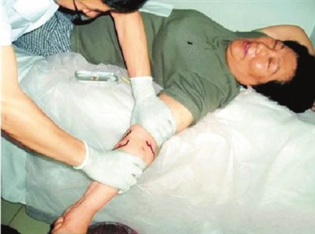 中医称放血850毫升治病 被方舟子质疑“不人性”--中国国情手册