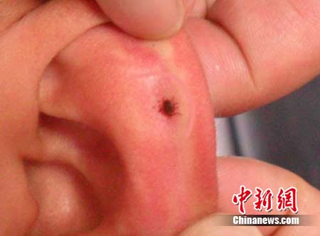 唐山首位蜱虫叮咬者渡过观察期 专家提醒勿恐慌--中国国情网